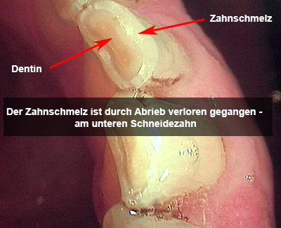 Stark durch knirschen und pressen abgenützte Zähne